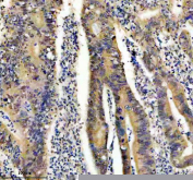 Immunohistochemical staining of FFPE human rectal cancer tissue with FTO antibody, HRP-secondary and DAB substrate. HIER: boil tissue sections in pH8 EDTA for 20 min and allow to cool before testing.