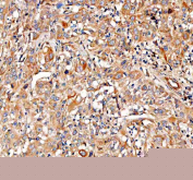 Immunohistochemical staining of FFPE human invasive urothelial carcinoma tissue with PKP3 antibody, HRP-secondary and DAB substrate. HIER: boil tissue sections in pH8 EDTA for 20 min and allow to cool before testing.