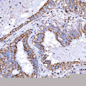 Immunohistochemical staining of FFPE human endometrioid adenocarcinoma tissue with RAB7A antibody, HRP-secondary and DAB substrate. HIER: boil tissue sections in pH8 EDTA for 20 min and allow to cool before testing.