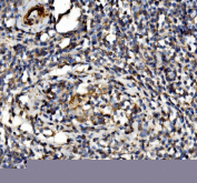 Immunohistochemical staining using EIF3D antibody on paraffin-embedded human testicular cancer tissue sections. Heat-induced epitope retrieval was performed using EDTA buffer (pH 8.0) prior to antibody incubation. Sections were blocked and incubated with EIF3D antibody overnight at 4C. Detection was carried out using an HRP-based secondary antibody with DAB as the chromogen. Staining shows cytoplasmic immunoreactivity in tumor cells. Nuclei were counterstained with hematoxylin.