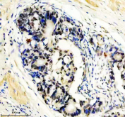 Immunohistochemical staining of FFPE human stomach cancer tissue using HIV Tat-specific factor 1 antibody, HRP-secondary and DAB substrate. HIER: boil tissue sections in pH8 EDTA for 20 min and allow to cool before testing.