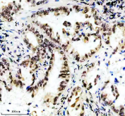 Immunohistochemical staining of FFPE human lung cancer tissue using HIV Tat-specific factor 1 antibody, HRP-secondary and DAB substrate. HIER: boil tissue sections in pH8 EDTA for 20 min and allow to cool before testing.