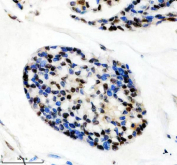 Immunohistochemical staining of FFPE human breast cancer tissue using HIV Tat-specific factor 1 antibody, HRP-secondary and DAB substrate. HIER: boil tissue sections in pH8 EDTA for 20 min and allow to cool before testing.