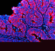 Immunofluorescent staining of FFPE human colon cancer tissue with TTF2 antibody (red) and DAPI nuclear stain (blue). HIER: steam section in pH8 EDTA buffer for 20 min.