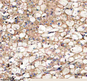 Immunohistochemistry analysis of Indian hedgehog protein using IHH antibody. Indian hedgehog protein expression was examined in a paraffin-embedded section of human liver cancer tissue. Heat-mediated antigen retrieval was performed using EDTA buffer (pH 8.0). Tissue sections were blocked with normal goat serum and incubated with IHH antibody overnight at 4Â°C. Signal was detected using an HRP-based detection system with DAB chromogen, followed by hematoxylin counterstaining.