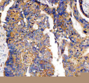 Immunohistochemistry analysis of Phosphodiesterase 4A using PDE4A antibody. Phosphodiesterase 4A expression was examined in a paraffin-embedded section of human colon cancer tissue. Heat-mediated antigen retrieval was performed using EDTA buffer (pH 8.0). Tissue sections were blocked with normal goat serum and incubated with PDE4A antibody overnight at 4Â°C. Immunoreactivity was visualized using an HRP-based detection system with DAB chromogen, followed by hematoxylin counterstaining.