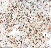 Immunohistochemical staining of FFPE human lung cancer tissue with TBX5 antibody, HRP-secondary and DAB substrate. HIER: boil tissue sections in pH8 EDTA for 20 min and allow to cool before testing.