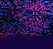 Immunofluorescence analysis of TBX5 using anti-TBX5 antibody. TBX5 expression was examined in a paraffin-embedded section of human lung cancer tissue. Heat-mediated antigen retrieval was performed using EDTA buffer (pH 8.0), followed by blocking with goat serum. The tissue section was incubated with a rabbit anti-TBX5 antibody overnight at 4Â°C, then stained with a Cy3-conjugated goat anti-rabbit secondary antibody. Nuclei were counterstained with DAPI. Fluorescent signals were visualized by fluorescence microscopy, revealing prominent nuclear localization of TBX5 consistent with its role as a transcription factor.