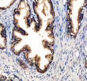 Immunohistochemistry analysis of PDLIM5 using anti-PDLIM5 antibody. PDLIM5 expression was examined in a paraffin-embedded section of human prostate cancer tissue. Heat-mediated antigen retrieval was performed in EDTA buffer (pH 8.0), followed by blocking with 10% goat serum. The tissue was incubated with rabbit anti-PDLIM5 antibody overnight at 4Â°C, then detected using an HRP-conjugated secondary antibody and DAB chromogen, revealing cytoplasmic staining in tumor cells.