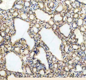 IHC analysis of UBXN1 in human thyroid cancer tissue. Paraffin-embedded human thyroid cancer tissue was analyzed for UBXN1 expression by immunohistochemistry. Heat-mediated antigen retrieval was performed in EDTA buffer (pH 8.0), and sections were blocked with 10% goat serum prior to incubation with a rabbit anti-UBXN1 antibody overnight at 4Â°C. Detection was performed using an HRP-conjugated secondary antibody with DAB chromogen, followed by hematoxylin counterstaining. UBXN1 shows cytoplasmic staining within tumor cells.
