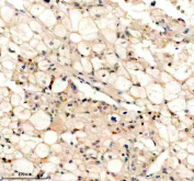 Immunohistochemistry analysis of Peroxisomal biogenesis factor 5 using PEX5 antibody. PEX5 expression was examined in a paraffin-embedded section of human liver cancer tissue. Heat-mediated antigen retrieval was performed using EDTA buffer (pH 8.0). Tissue sections were blocked with normal goat serum and incubated with PEX5 antibody overnight at 4C. Immunoreactivity is observed predominantly in tumor epithelial cells, with cytoplasmic staining consistent with peroxisomal localization. Detection was visualized using an HRP-based detection system with DAB chromogen, followed by hematoxylin counterstaining.
