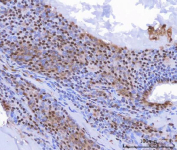 IHC analysis of c-Myc in human thyroid cancer tissue. Paraffin-embedded human thyroid cancer tissue was stained with c-Myc / MYC antibody following pH8 EDTA heat-mediated antigen retrieval. Nuclear immunoreactivity is observed in tumor cells, consistent with c-Myc expression in thyroid malignancy. Scale bar: 100 um.