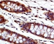 IHC testing of FFPE human colon tissue with Caspase-3 antibody at 5ug/ml. HIER: steam tissue sections in pH6, 10mM citrate buffer, for 10-20 min followed by cooling at RT for 20 min.
