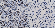 ICC staining of 293T cells expressing His-Tag nuclear protein X (left) and negative control HepG2 cells (right) using the recombinant His Tag antibody.