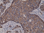 IHC testing of FFPE human breast cancer tissue with recombinant HER2 antibody. Expected molecular weight: ~138 kDa (unmodified), ~185 kDa (glycosylated).