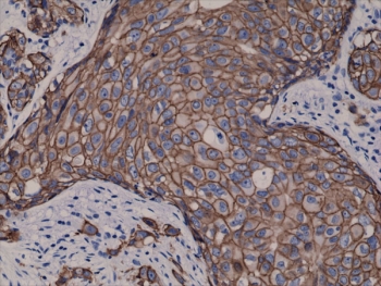 IHC testing of FFPE human breast cancer tissue with recombinant HER2 antibody. Expected molec