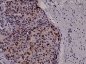 IHC testing of FFPE human breast cancer tissue with recombinant Cyclin D1 antibody at 1:1000.