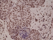 IHC testing of FFPE human breast cancer tissue with recombinant phospho-p38 antibody at 1:1000.