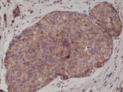 IHC testing of FFPE human breast cancer tissue with recombinant E-Cadherin antibody at 1:1000.