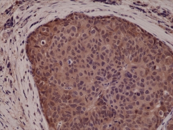 IHC testing of FFPE human breast cancer tissue with recombinant p38 antibody at 1:5000.~