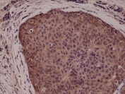 IHC testing of FFPE human breast cancer tissue with recombinant p38 antibody at 1:5000.