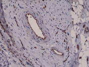 IHC testing of FFPE human breast cancer tissue with recombinant CD31 antibody at 1:2500.
