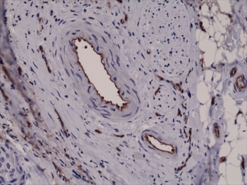 IHC testing of FFPE human breast cancer tissue with recombinant CD31