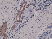 IHC testing of FFPE human breast cancer tissue with recombinant CD146 antibody at 1:400.