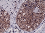 IHC testing of FFPE human breast cancer tissue with recombinant Caspase-3 antibody at 1:2500.