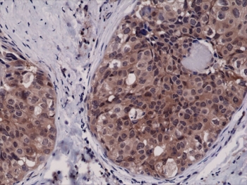 IHC testing of FFPE human breast cancer tissue with recombinant Caspase-3 antibody at 1:2500.