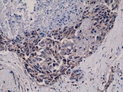 IHC testing of FFPE human breast cancer tissue with recombinant phospho-AKT antibody at 1:400.