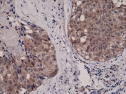 IHC testing of FFPE human breast cancer tissue with recombinant AKT1 antibody at 1:1000.