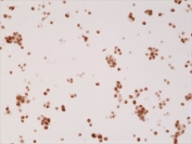 ICC testing of FFPE human 22RV1 cells (prostate carcinoma) with recombinant Androgen Receptor antibody at 1:2500.