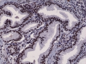 IHC testing of FFPE human prostate cancer tissue with recombinant Androgen Receptor antibody at 1:2500.