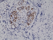 IHC testing of FFPE human breast cancer tissue with recombinant phospho-Stat3 antibody at 1:10,000.