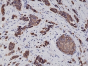 IHC testing of FFPE human breast cancer tissue with recombinant CK8 antibody at 1:2000.