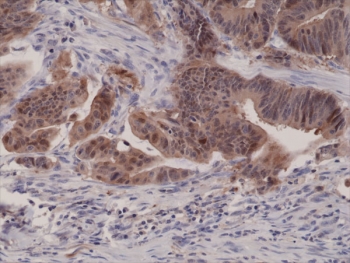 IHC testing of FFPE human colon cancer tissue with recombinant p16INK4a antibody at 1:1000. ~