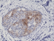 IHC testing of FFPE human breast cancer tissue with recombinant phospho-EGFR antibody at 1:5000.
