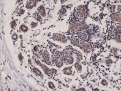 IHC testing of FFPE human breast cancer tissue with recombinant Smac antibody at 1:1000.