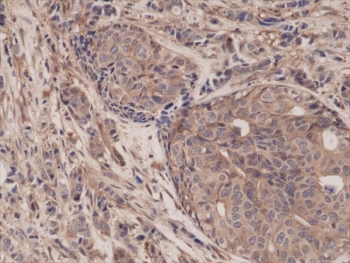 IHC testing of FFPE human breast cancer tissue with recombinant p65 antibody at 1:1250. ~