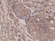 IHC testing of FFPE human breast cancer tissue with recombinant p65 antibody at 1:1250. 