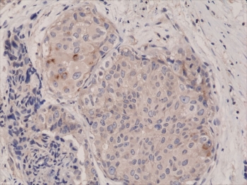 IHC testing of FFPE human breast cancer tissue with recombinant mTOR antibody at 1:1000.