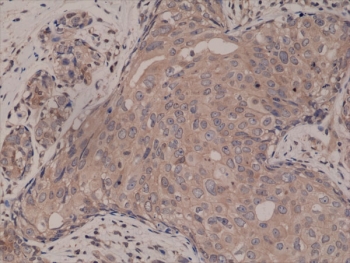 IHC testing of FFPE human breast cancer tissue with recombinant SMAD4 antibody at 1:2000.