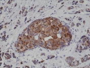 IHC testing of FFPE human breast cancer tissue with recombinant Cytokeratin 18 antibody at 1:4000.