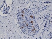 IHC testing of FFPE human breast cancer tissue with recombinant Cyclin B1 antibody at 1:2000.