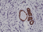 IHC testing of FFPE human breast cancer tissue with recombinant CK7 antibody at 1:1000.