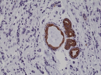 IHC testing of FFPE human breast cancer tissue with recombinant CK7 antibody at 1:1000.