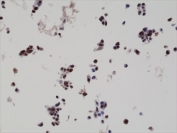 IHC staining of formalin fixed and paraffin embedded human LNCaP cells overexpressing HA-tag Bag1 protein, using HA-Tag antibody at 0.01 ug/ml.