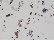 IHC staining of formalin fixed and paraffin embedded human LNCaP cells overexpressing HA-tag Bag1 protein, using biotinylated HA-Tag antibody at 0.01 ug/ml.