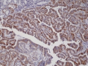 IHC staining of formalin fixed and paraffin embedded thyroid carcinoma tissue with recombinant BRAF V600E antibody. Allele specific PCR validated to be positive for BRAF V600E. HIER: steam section in pH6 citrate buffer for 20 min and allow to cool prior to testing.